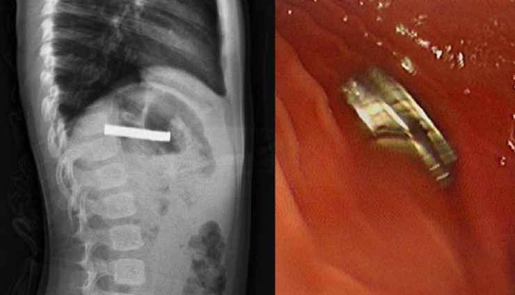 Çocuğun boğazından 19 adet mıknatıs çıkartıldı