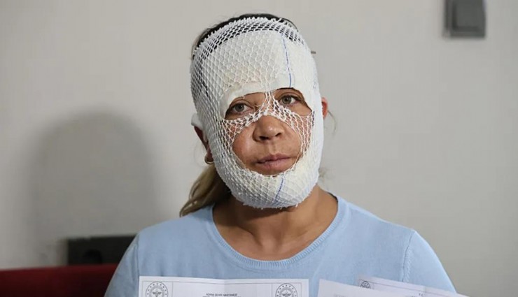 Adana'da güzellik kabusu: Prenses bakımı yüzünü yaktı, çocuğu korkup yaralandı